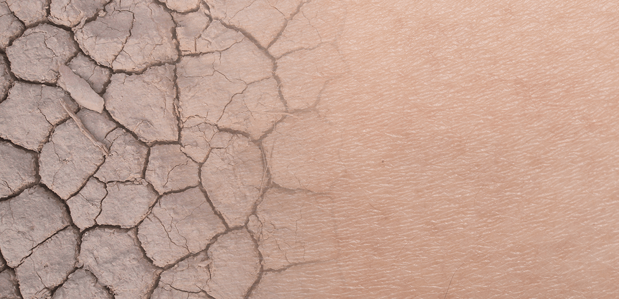 11 goede gewoontes voor het verzorgen van een droge en geïrriteerde huid