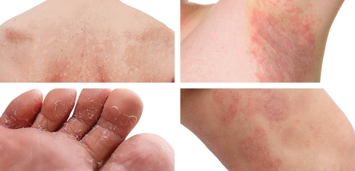 Een schimmelinfectie van de huid of huidschimmel herkennen en verzorgen