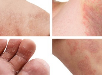 Een schimmelinfectie van de huid of huidschimmel herkennen en verzorgen