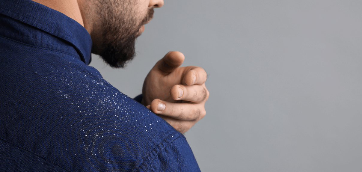 Pellicules : causes, solutions et astuces pour s’en débarrasser