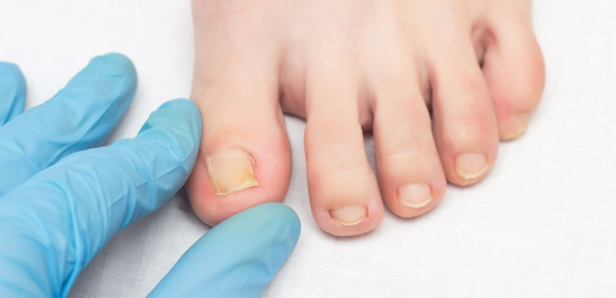 Nail mycosis (foot and hand): recognising and treating the infection