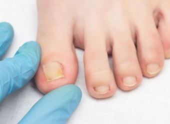 Nail mycosis (foot and hand): recognising and treating the infection