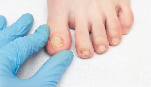 nail fungus
