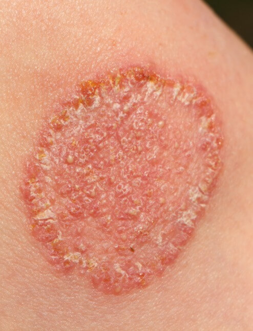 Riconoscere E Curare Una Micosi Della Pelle O Una Micosi Cutanea Riconoscere E Curare Una Micosi Della Pelle O Una Micosi Cutanea