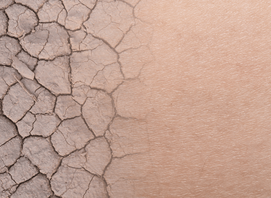 11 buenos hábitos para el cuidado de la piel seca e irritada